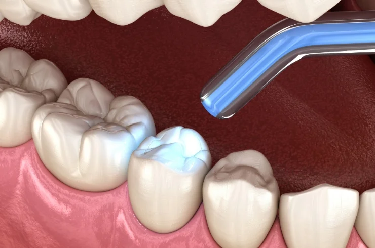 Fillings and Restorations