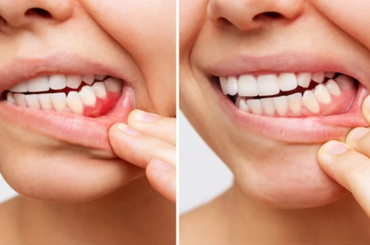 Periodontal Treatment