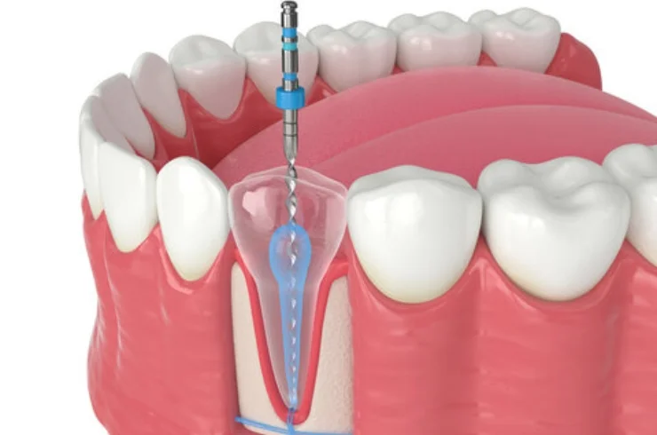 Root Canal Treatment