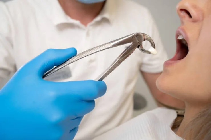 Wisdom Teeth Extraction